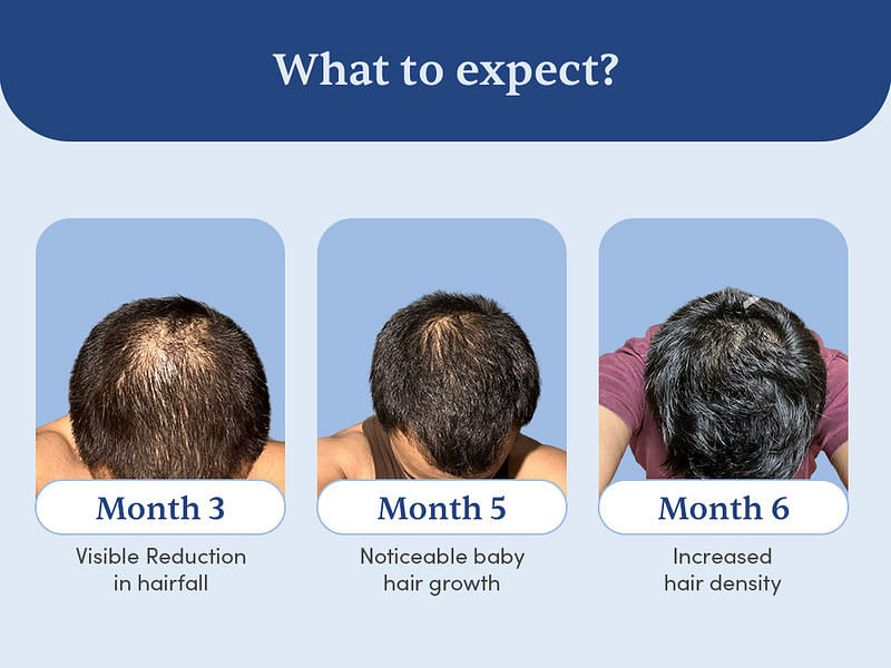 Stage 3 / Stage 4 Hairfall Solution (3 Months Pack)